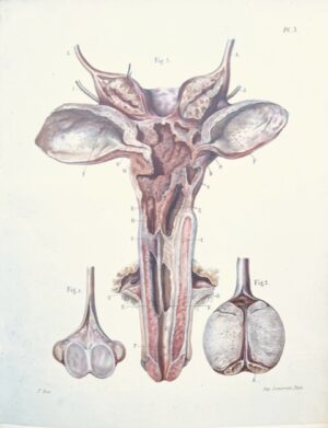 DUFOUR (Charles). Thèse pour le Doctorat en médecine, présentée et soutenue le 31 août 1854. Étude sur la tuberculation des organes génito-urinaire.